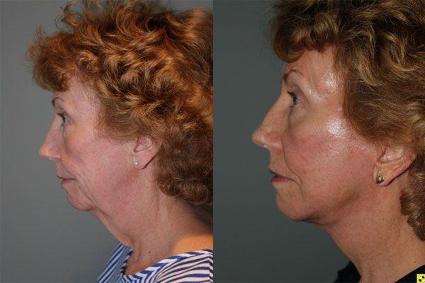 Kalos Facial Plastic Surgery facelift result — Alpharetta, GA