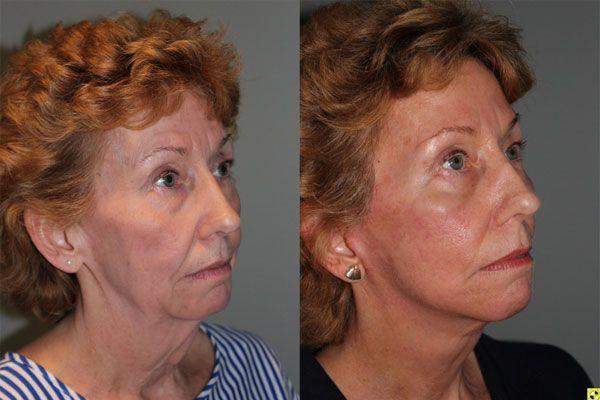 Kalos Facial Plastic Surgery facelift result — Alpharetta, GA