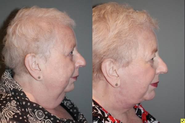 Kalos Facial Plastic Surgery facelift result — Alpharetta, GA