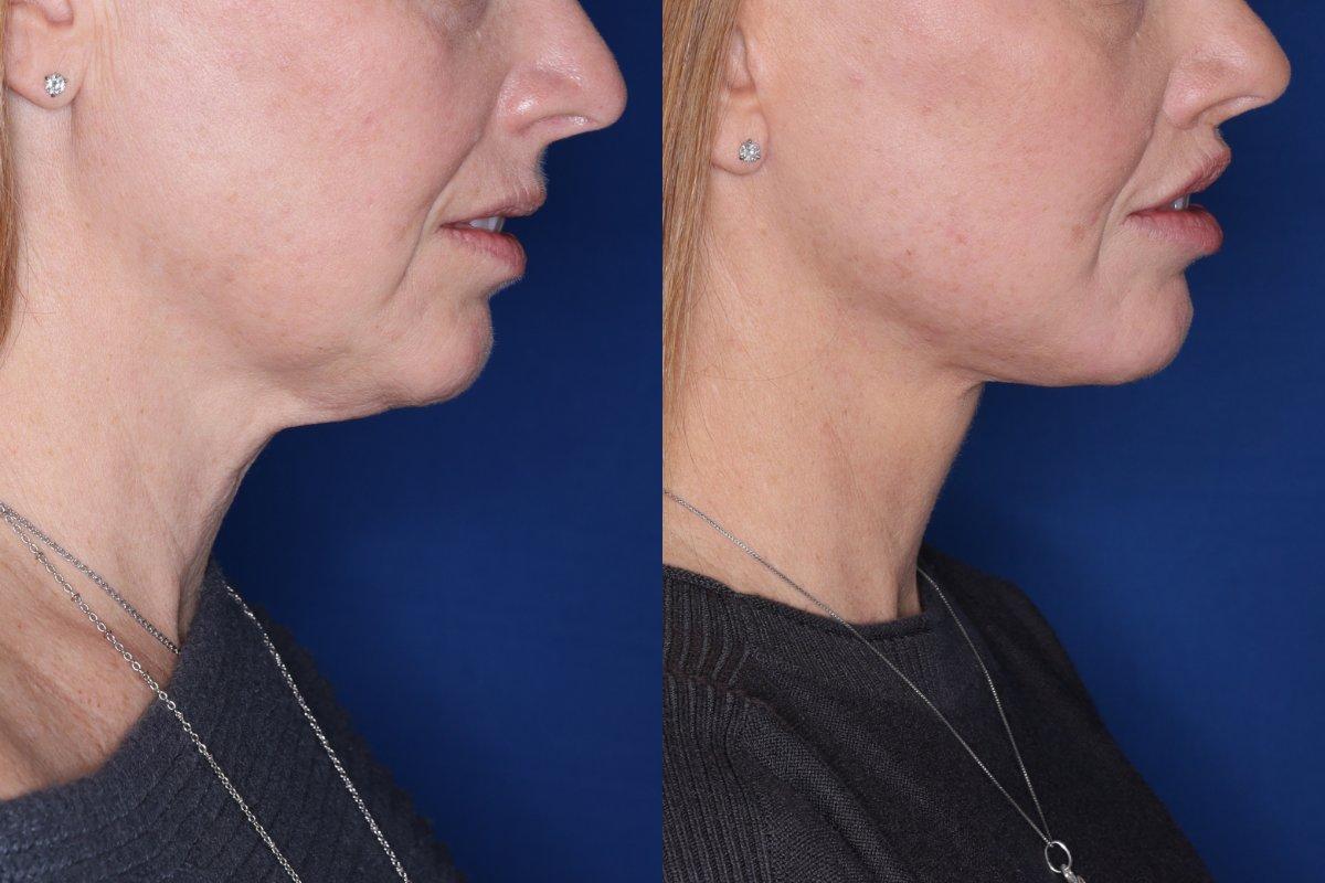 Kalos Facial Plastic Surgery facelift result — Alpharetta, GA