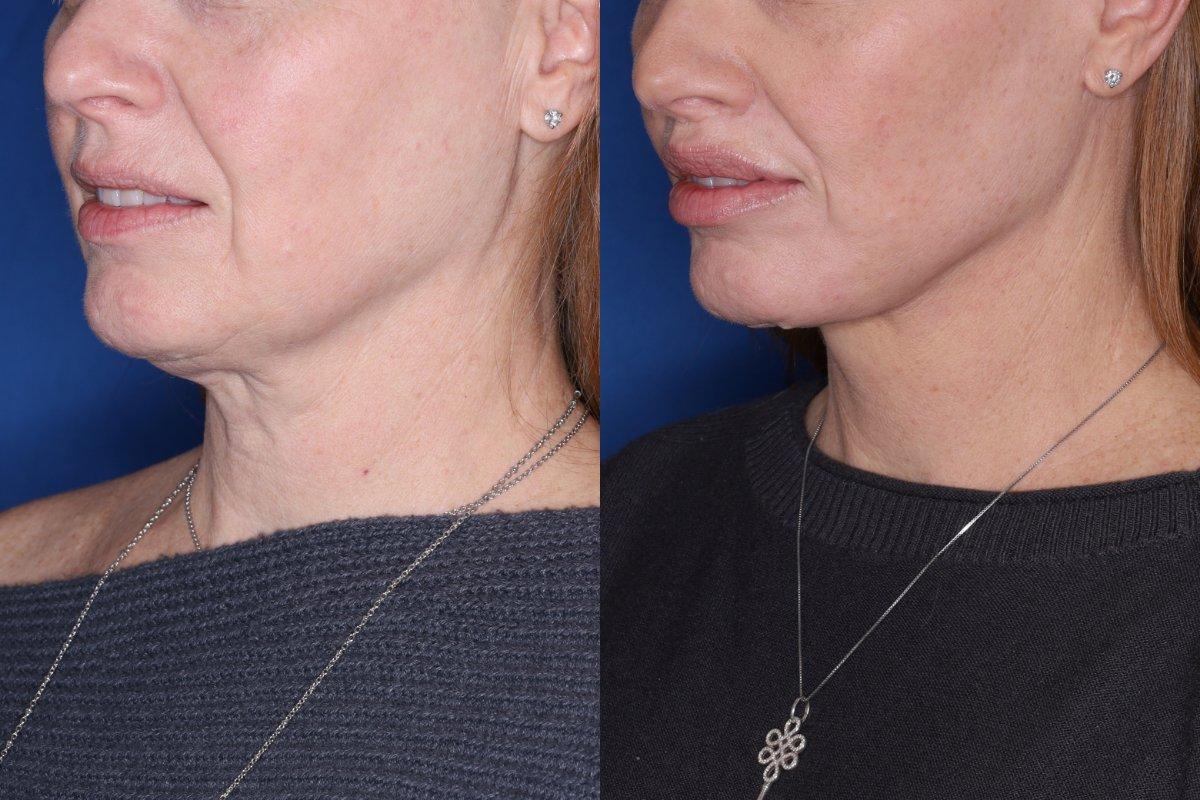 Kalos Facial Plastic Surgery facelift result — Alpharetta, GA