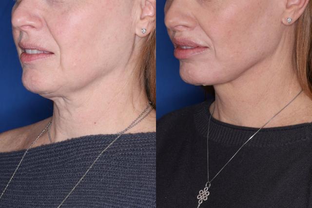 Facelift result at Kalos Facial Plastic Surgery in Alpharetta, GA