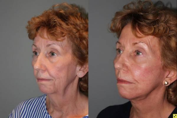 Kalos Facial Plastic Surgery facelift result — Alpharetta, GA