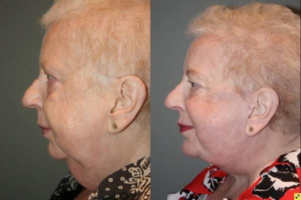 Kalos Facial Plastic Surgery facelift result — Alpharetta, GA