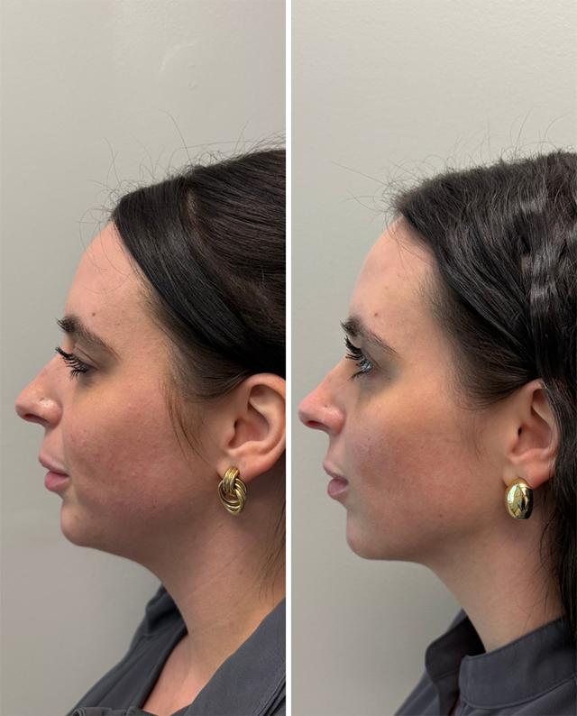 Botox result at SkinCeuticals SkinLab Charleston in Charleston, SC