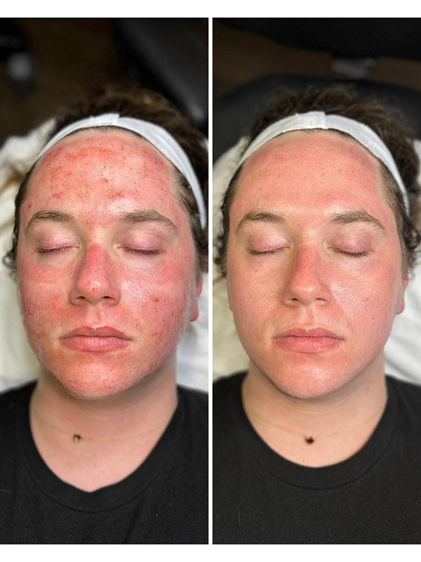 SkinCeuticals SkinLab Charleston laser treatment result — Charleston, SC