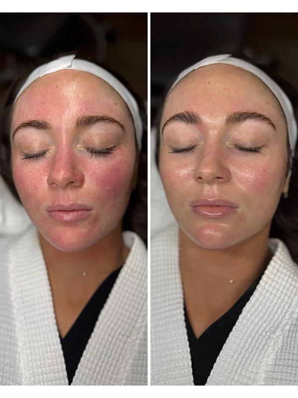 Laser Skin Resurfacing result at SkinCeuticals SkinLab Charleston in Charleston, SC