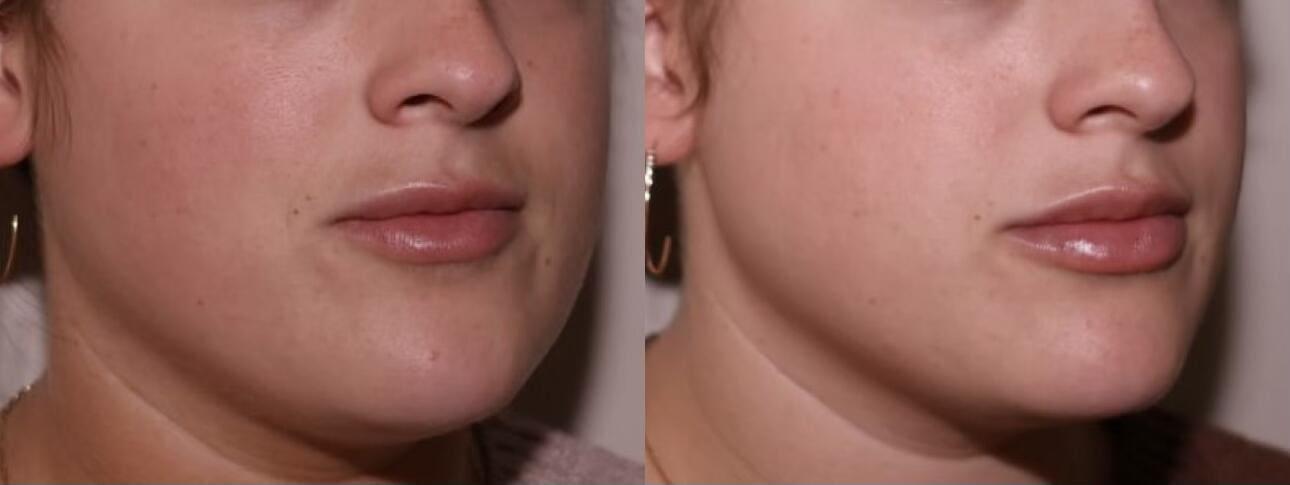 SKN at Franks Dermatology lip filler result — Little Rock, AR