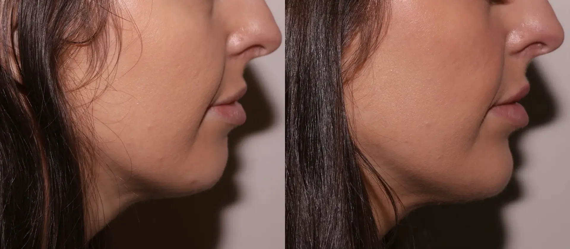 SKN at Franks Dermatology lip filler result — Little Rock, AR