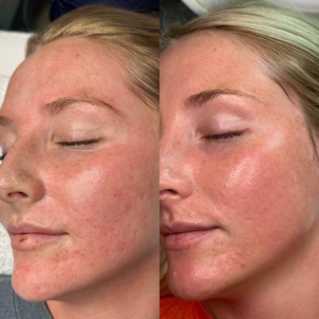 Chemical Peel result at SKN at Franks Dermatology in Little Rock, AR