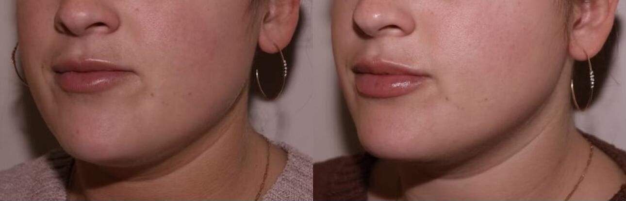 SKN at Franks Dermatology lip filler result — Little Rock, AR