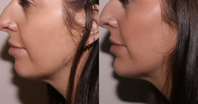 Juvederm result at SKN at Franks Dermatology in Little Rock, AR