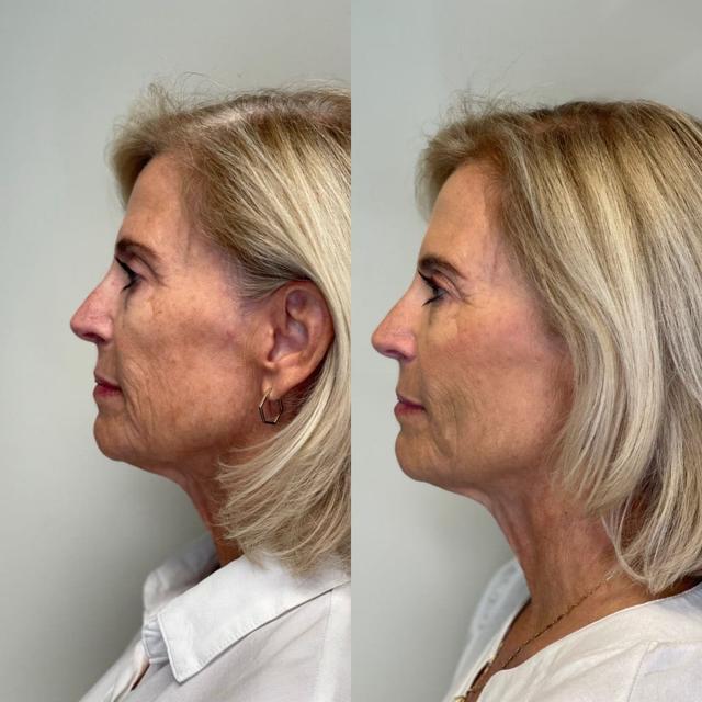 Deep Plane Facelift result at SKN at Franks Dermatology in Little Rock, AR