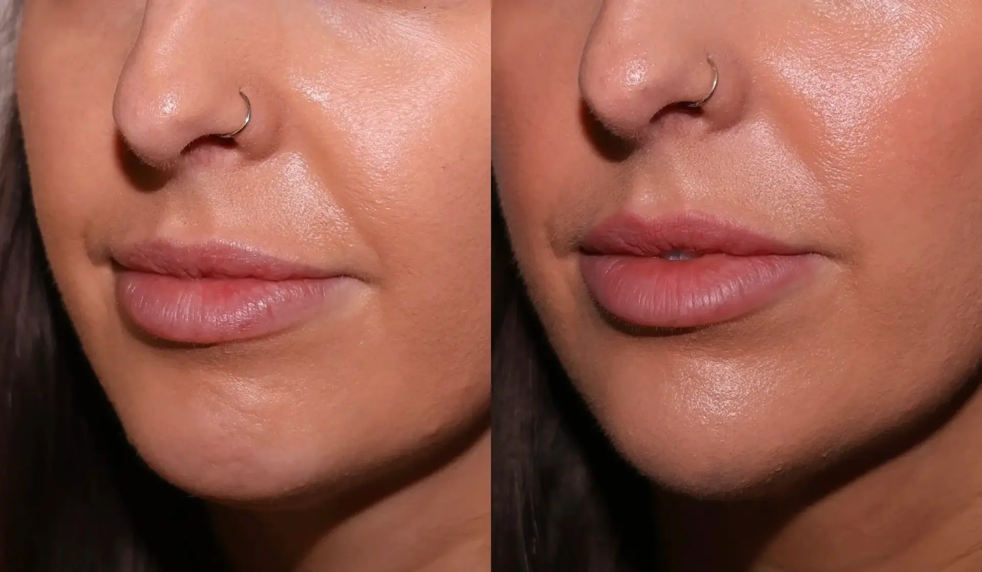 SKN at Franks Dermatology jawline filler result — Little Rock, AR