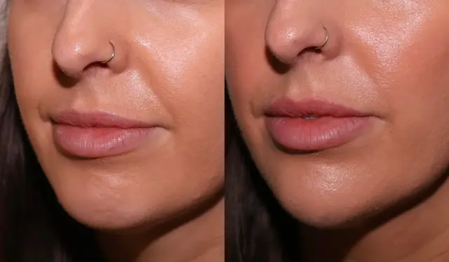 Jawline Filler result at SKN at Franks Dermatology in Little Rock, AR