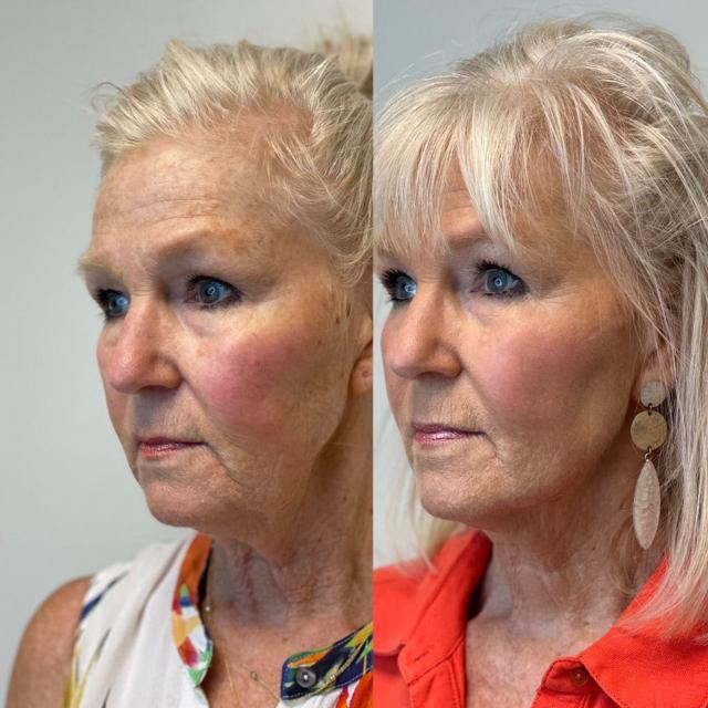 Deep Plane Facelift result at SKN at Franks Dermatology in Little Rock, AR