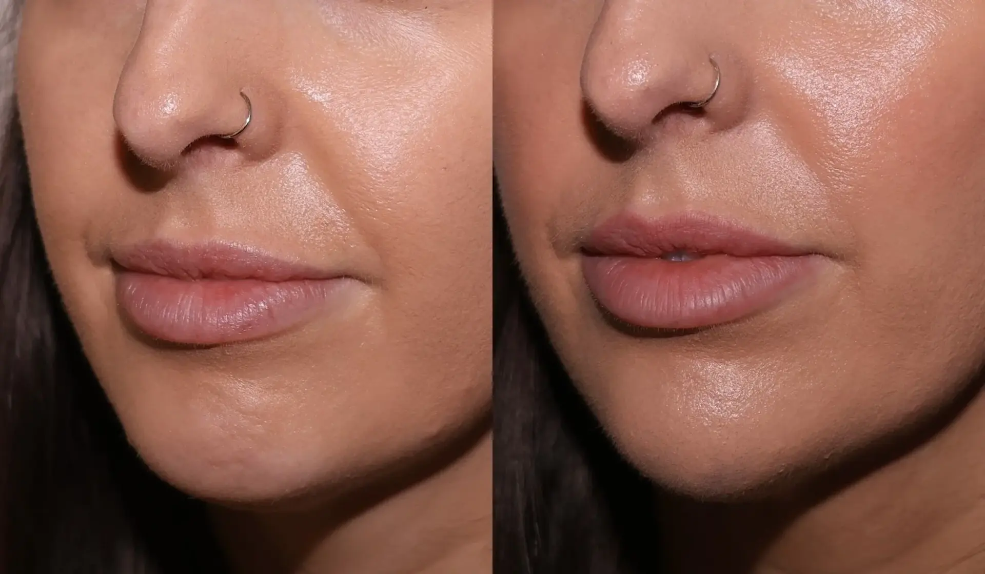 SKN at Franks Dermatology lip filler result — Little Rock, AR