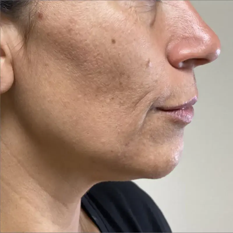 Integracare Medical care and Aesthetics thread lift after — Vineyard, UT