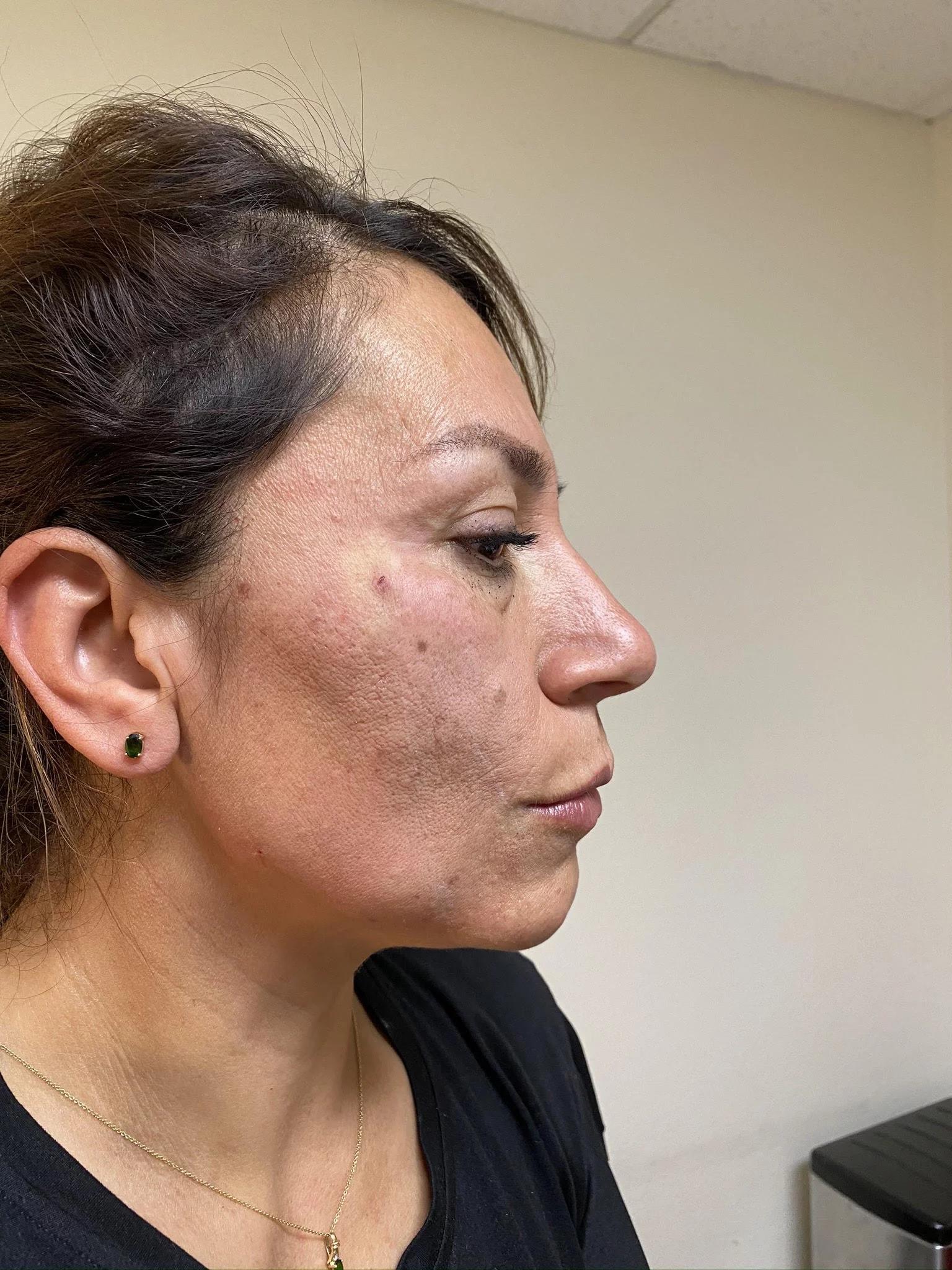 Integracare Medical care and Aesthetics thread lift after — Vineyard, UT