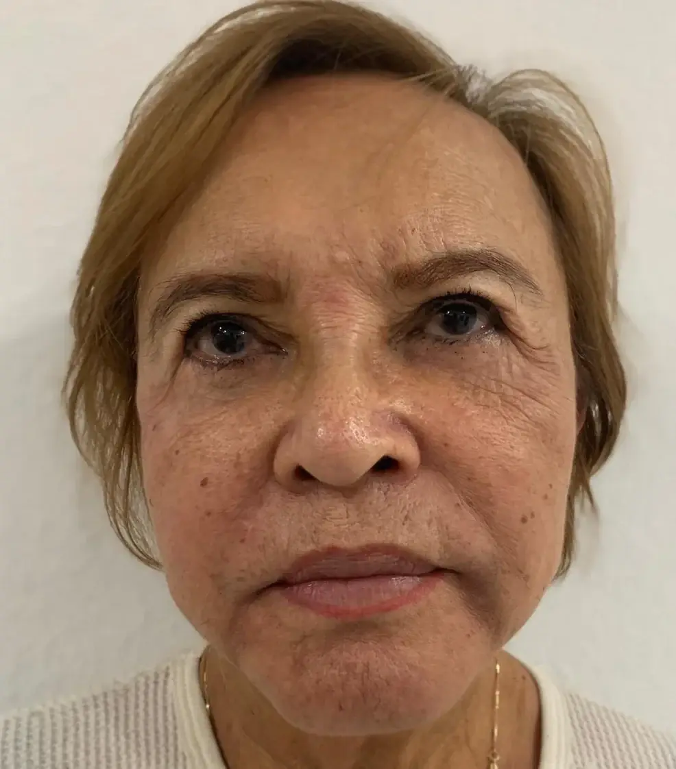 Integracare Medical care and Aesthetics thread lift after — Vineyard, UT