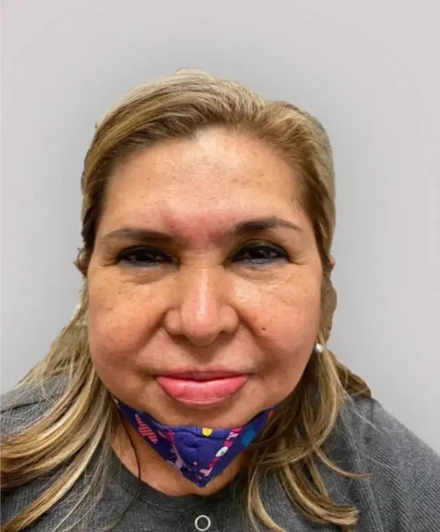 Microneedling before at Integracare Medical care and Aesthetics in Vineyard, UT