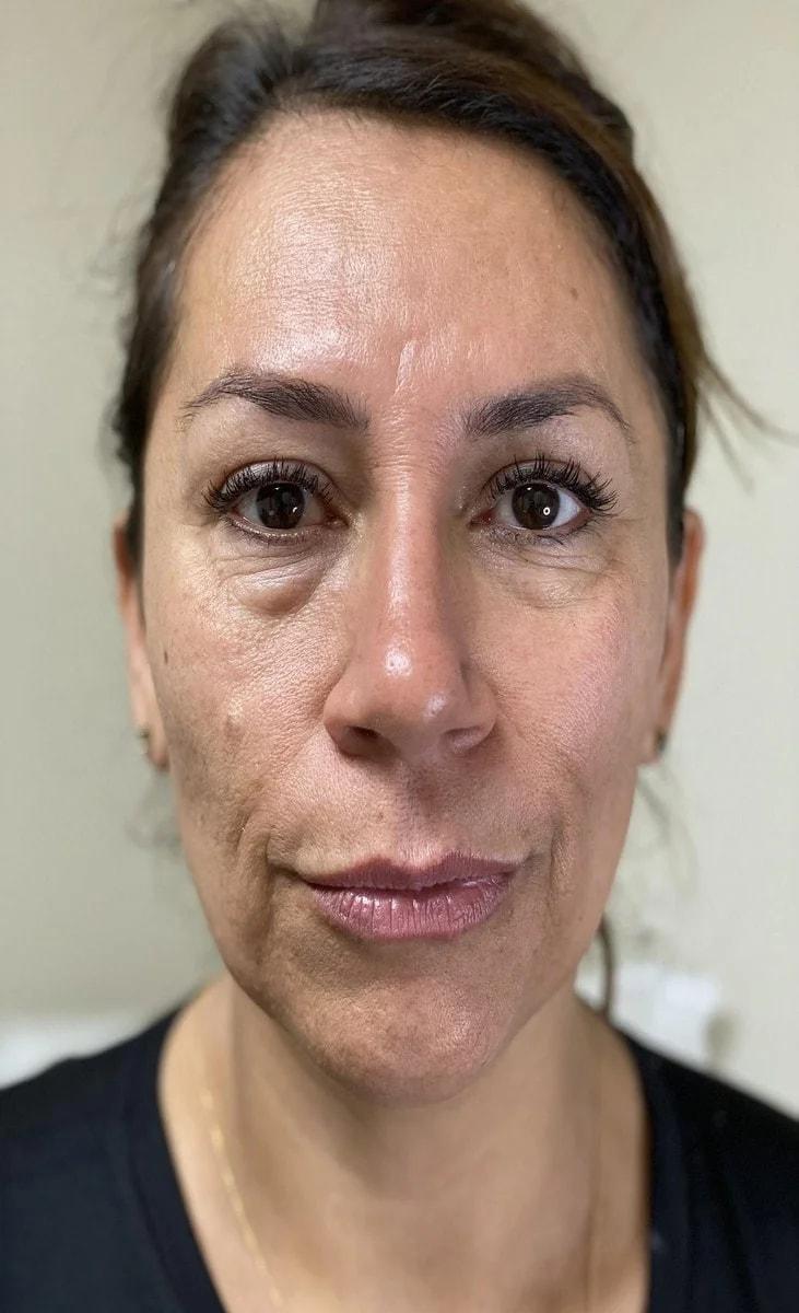 Integracare Medical care and Aesthetics thread lift after — Vineyard, UT