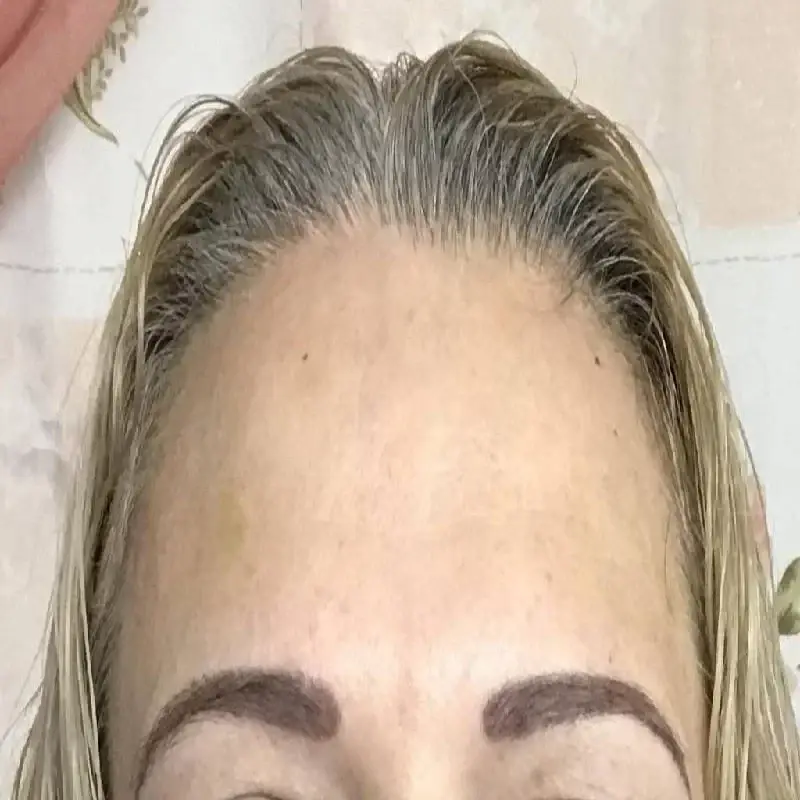 Integracare Medical care and Aesthetics botox after — Vineyard, UT