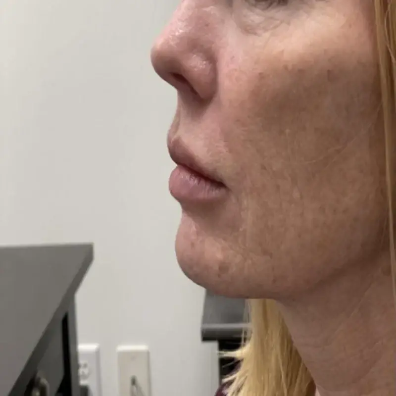 Integracare Medical care and Aesthetics lip filler after — Vineyard, UT