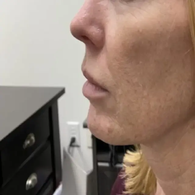 Lip Filler before at Integracare Medical care and Aesthetics in Vineyard, UT