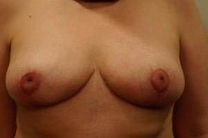 Breast Reduction after at DeRosa Plastic Surgery - Amy P. DeRosa, DO in West Bloomfield Township, MI