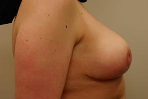 Breast Reduction after at DeRosa Plastic Surgery - Amy P. DeRosa, DO in West Bloomfield Township, MI