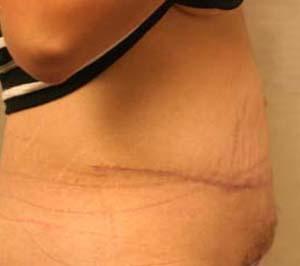 DeRosa Plastic Surgery - Amy P. DeRosa, DO tummy tuck after — West Bloomfield Township, MI