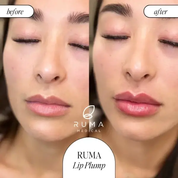 Lip Filler result at RUMA Medical in Lehi, UT