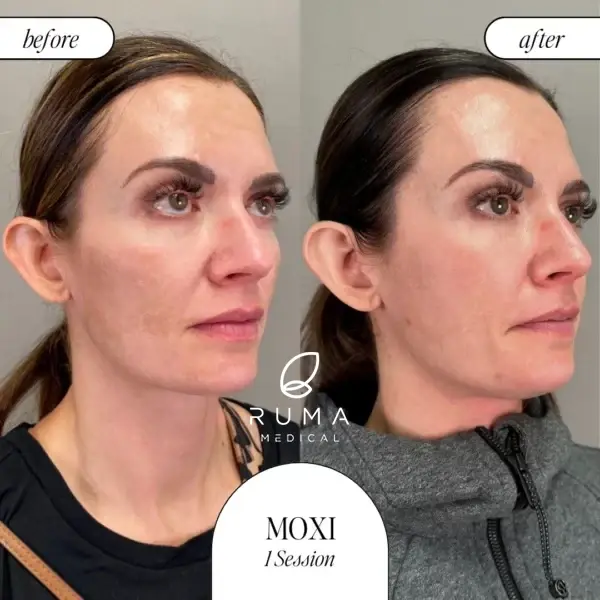 Laser Skin Resurfacing result at RUMA Medical in Lehi, UT