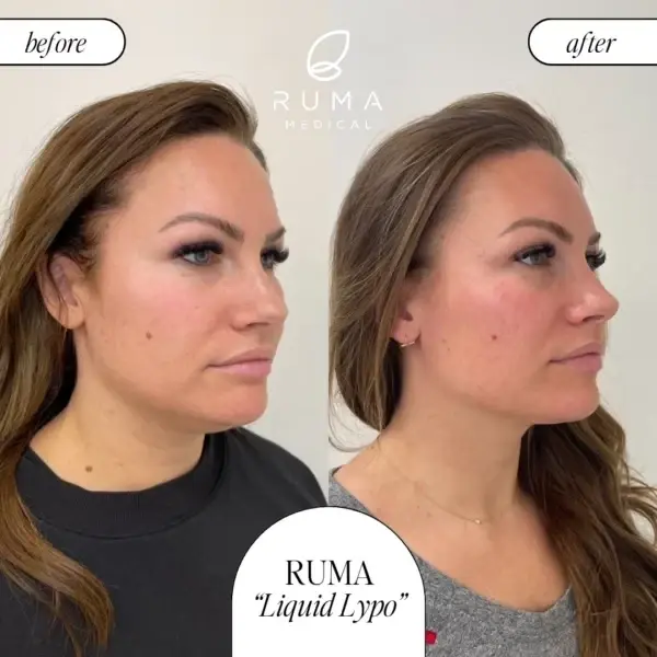RUMA Medical double chin treatment result — Lehi, UT