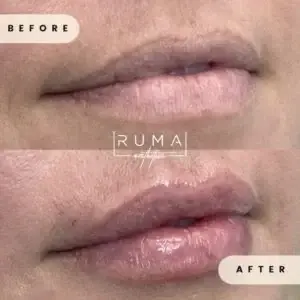 RUMA Medical lip filler result — Lehi, UT