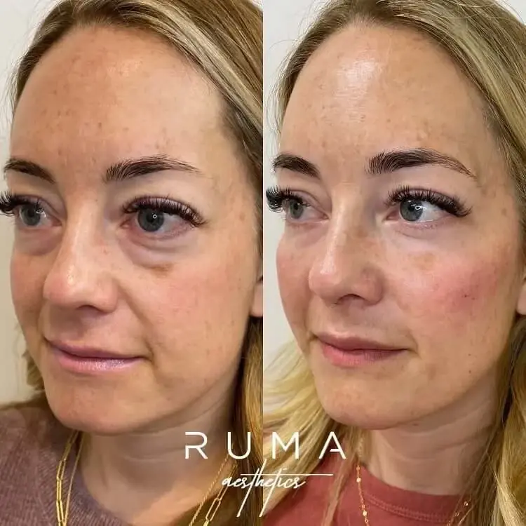 RUMA Medical under-eye filler result — Lehi, UT