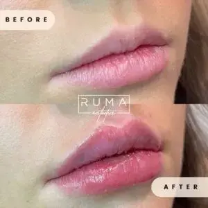 RUMA Medical lip filler result — Lehi, UT