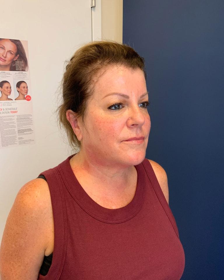 Advanced Plastic Surgery of North Shore (Mahira Tanovic, MD) skin tightening after — New Hyde Park, NY