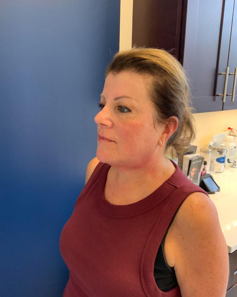 Advanced Plastic Surgery of North Shore (Mahira Tanovic, MD) skin tightening after — New Hyde Park, NY