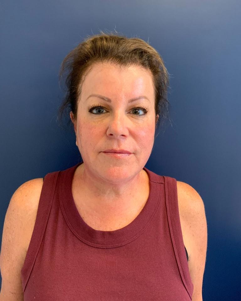 Advanced Plastic Surgery of North Shore (Mahira Tanovic, MD) skin tightening after — New Hyde Park, NY