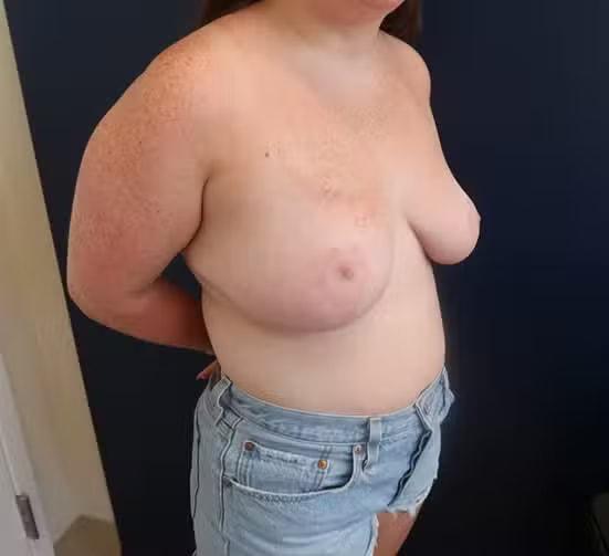 Advanced Plastic Surgery of North Shore (Mahira Tanovic, MD) breast reduction after — New Hyde Park, NY