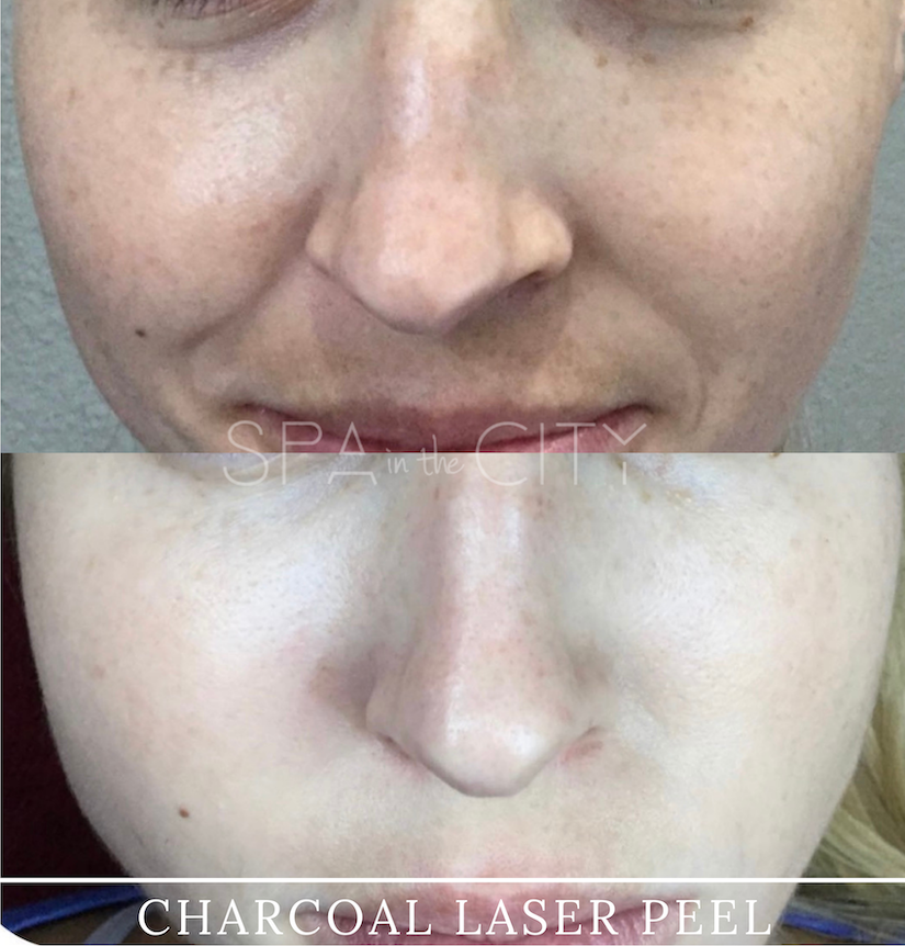 Well Labs+ Medspa Dallas chemical peel result — Dallas, TX