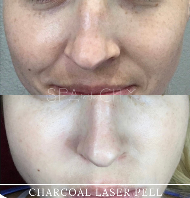 Chemical Peel result at Well Labs+ Medspa Dallas in Dallas, TX