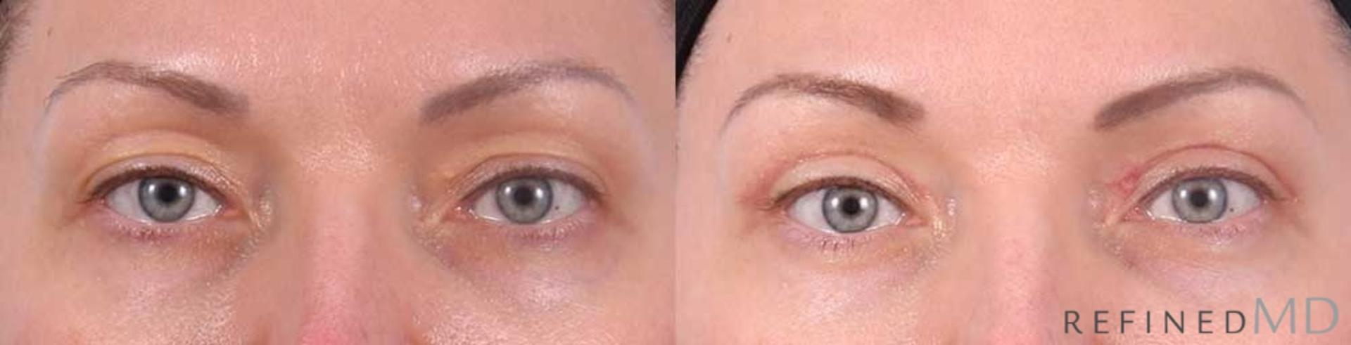 RefinedMD eyelid lift result — Los Gatos, CA