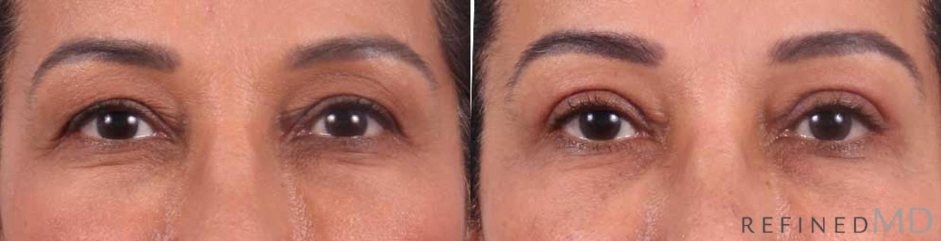 RefinedMD eyelid lift result — Los Gatos, CA