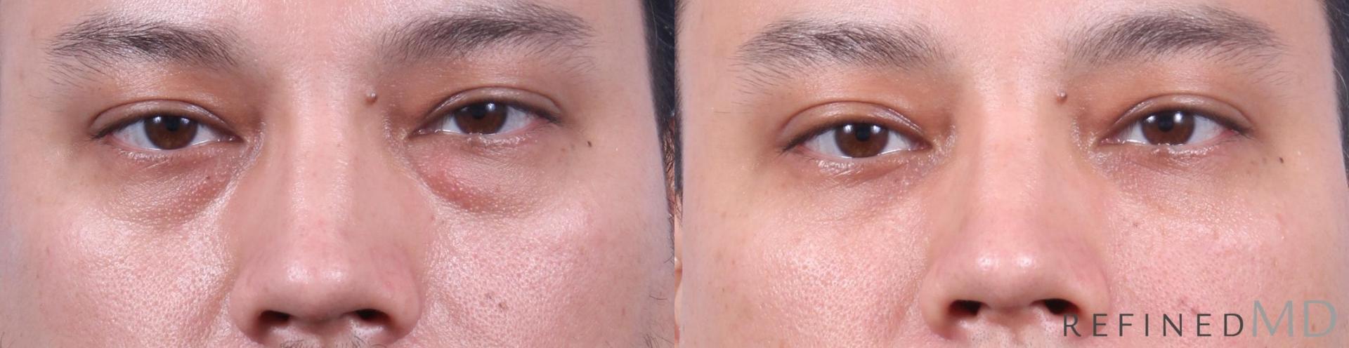 RefinedMD eyelid lift result — Los Gatos, CA