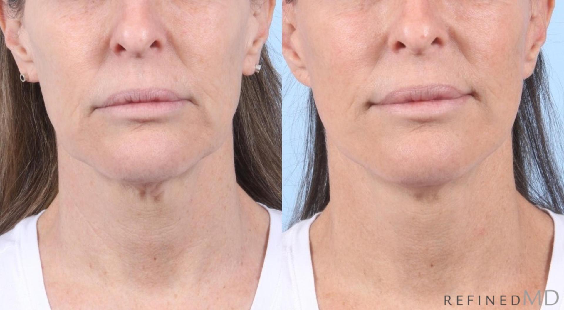 RefinedMD facelift result — Los Gatos, CA