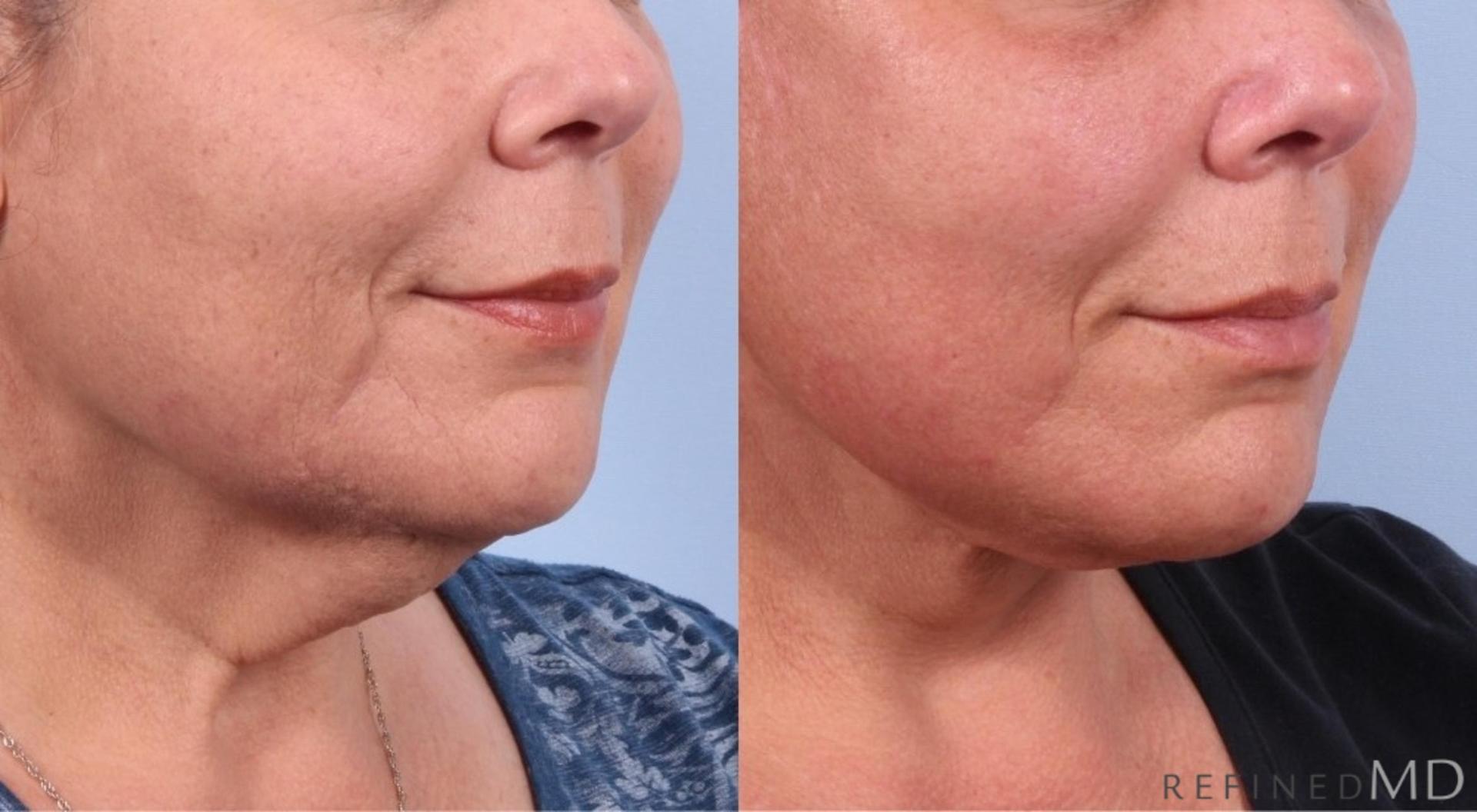 RefinedMD facelift result — Los Gatos, CA