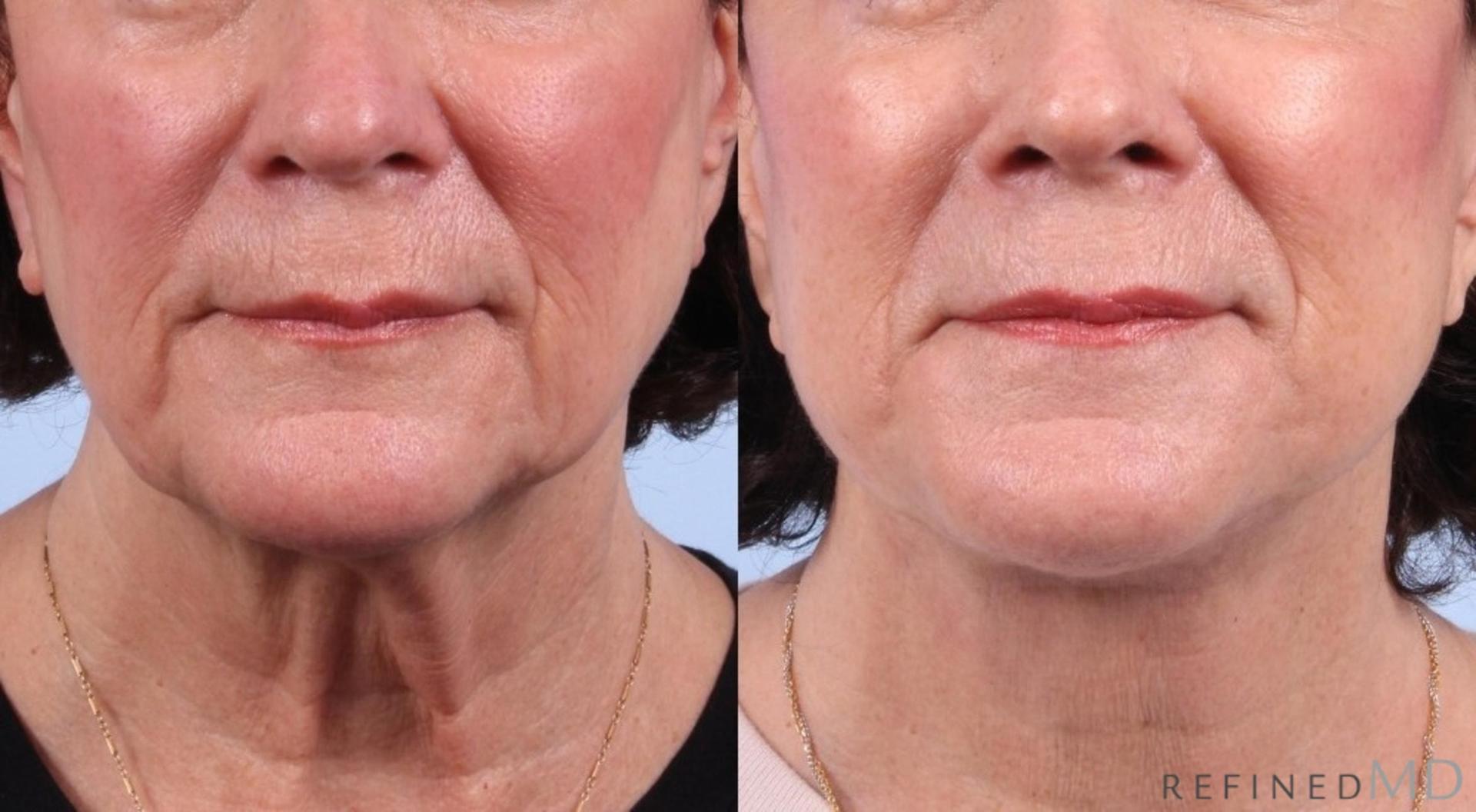 RefinedMD facelift result — Los Gatos, CA